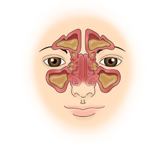 부비동에 생긴 염증