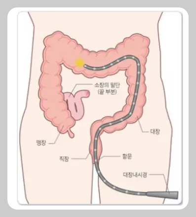 대장내시경