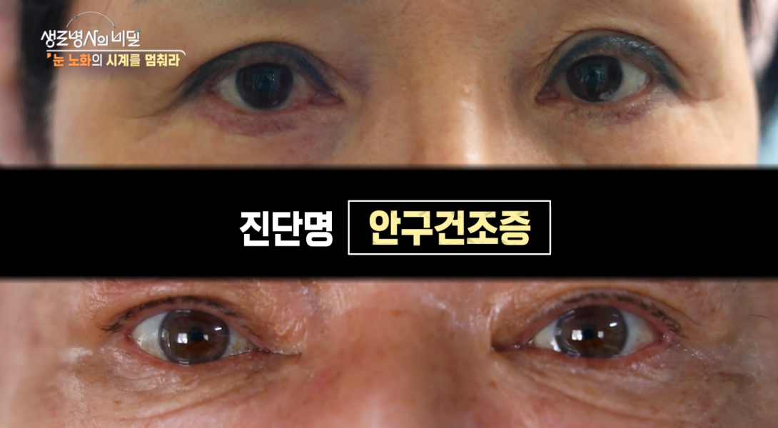 생로병사의비밀 눈노화