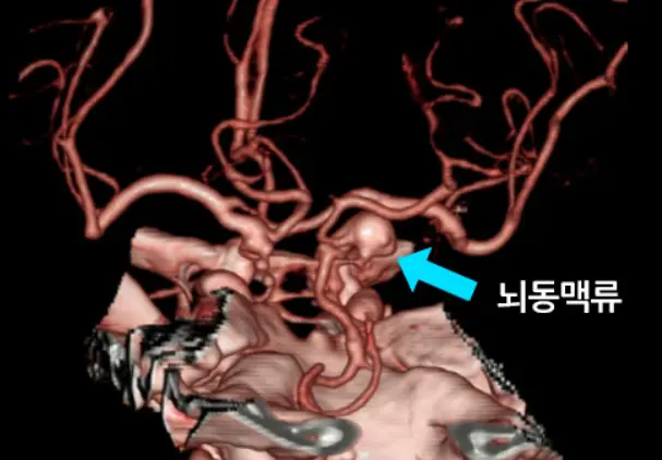 뇌동맥류 증상