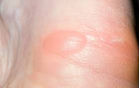 화상 물집 치료방법