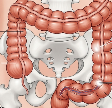 대장내시경-사진4