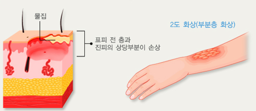 2도 화상 설명