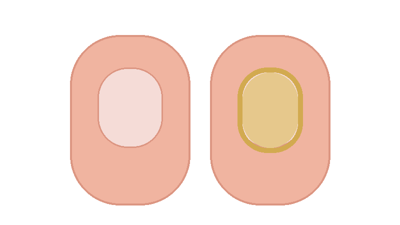 손톱이 두꺼워지는 이유(조갑비후) 총정리: 무좀·외상·건선·노화까지 원인별 감별법