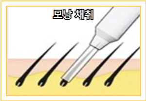 탈모 치료 - 모발 이식