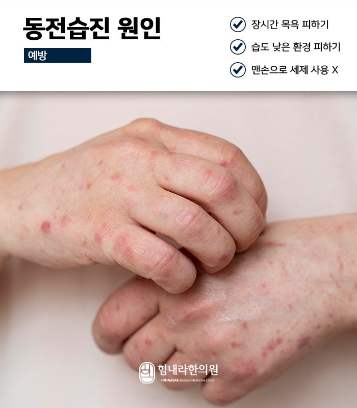 습진 가려움