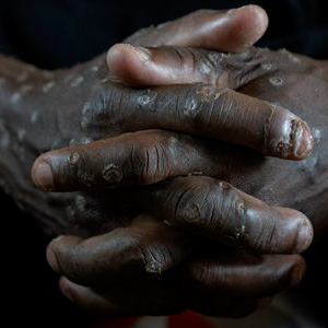 원숭이두창 엠폭스 관련주 대장주 테마주 TOP7