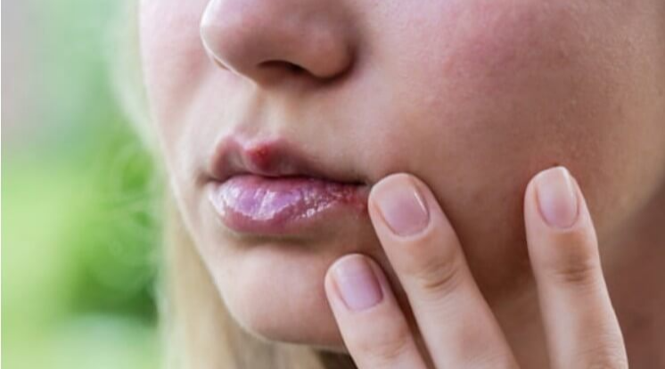 혓바닥에-관련된-병