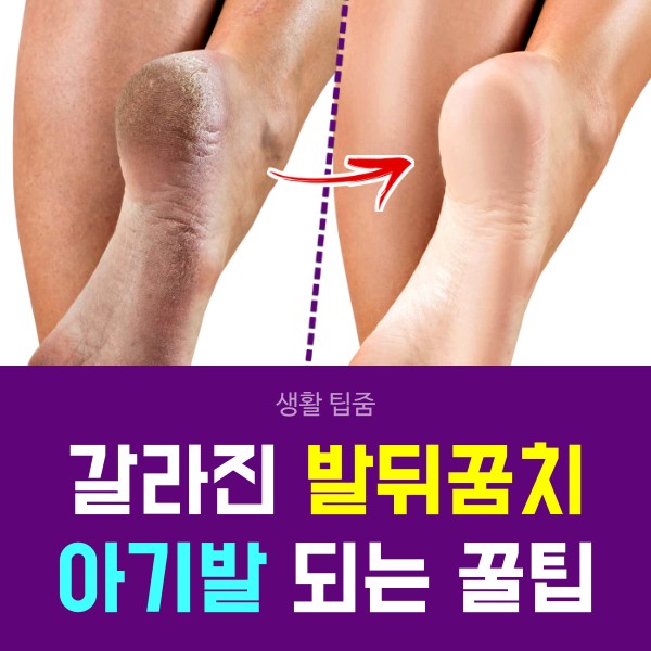 발뒤꿈치 각질제거 갈라짐,뒤꿈치 굳은살 제거,레몬껍질,풋크림