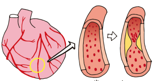 협심증이나 심근경색이 일어나는 메커니즘