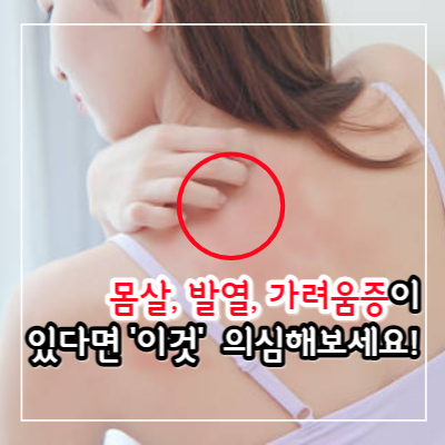 대상포진 초기증상과 예방접종 가격비교