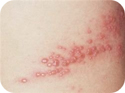 대상포진-발진(수포)사진