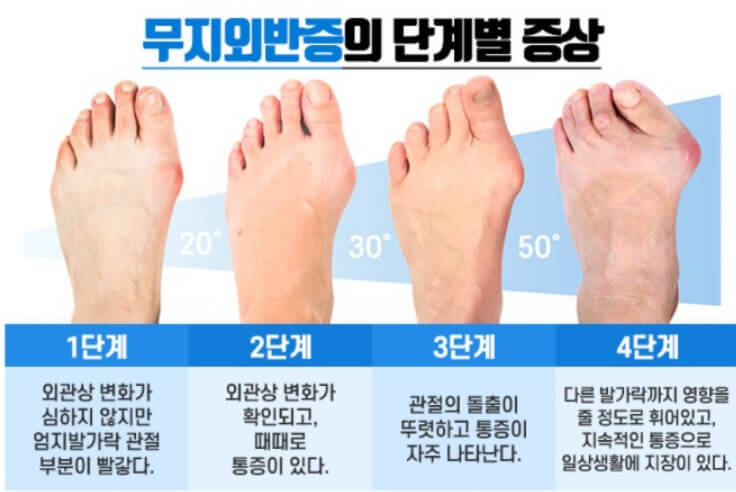 무지외반증 단계별 발가락 각도
