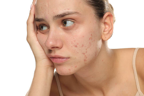 여드름 자국 없애는 가장 빠른 방법? 색소침착 레이저 치료 관리법