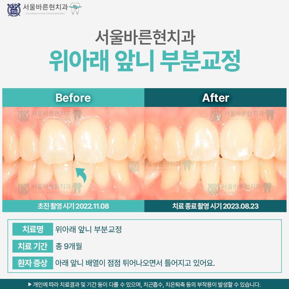 마린시티치아교정