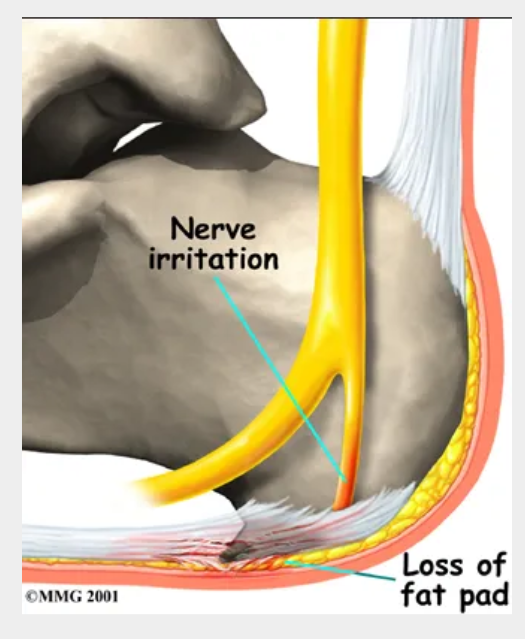 족저-근막염-치료법