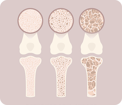골다공증-치료방법