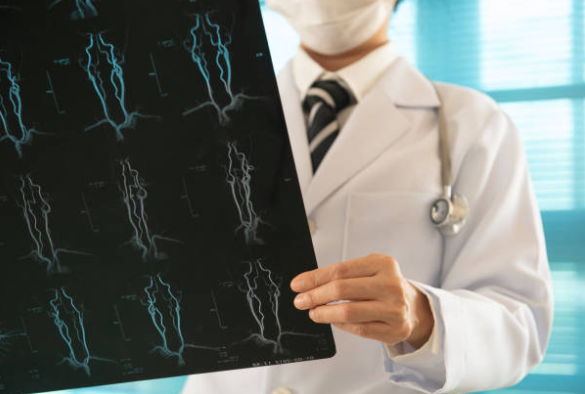 모야모야병 원인, 증상, 진단, 치료와 예방 방법, 합병증