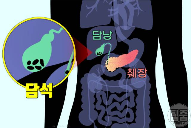 담석증 증상 초기증상 원인 치료