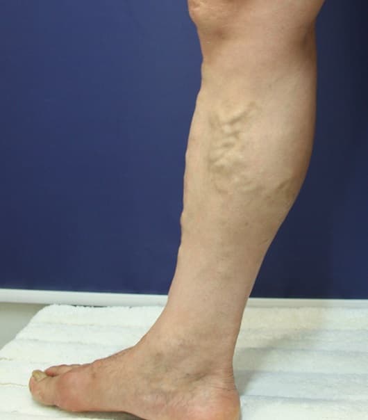 혈관이 튀어나온 하지정맥류란?