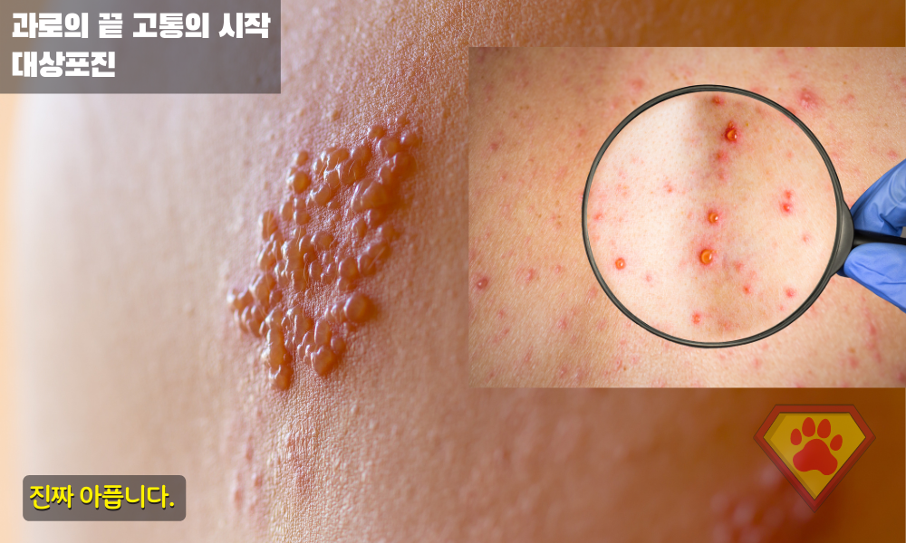 대상포진