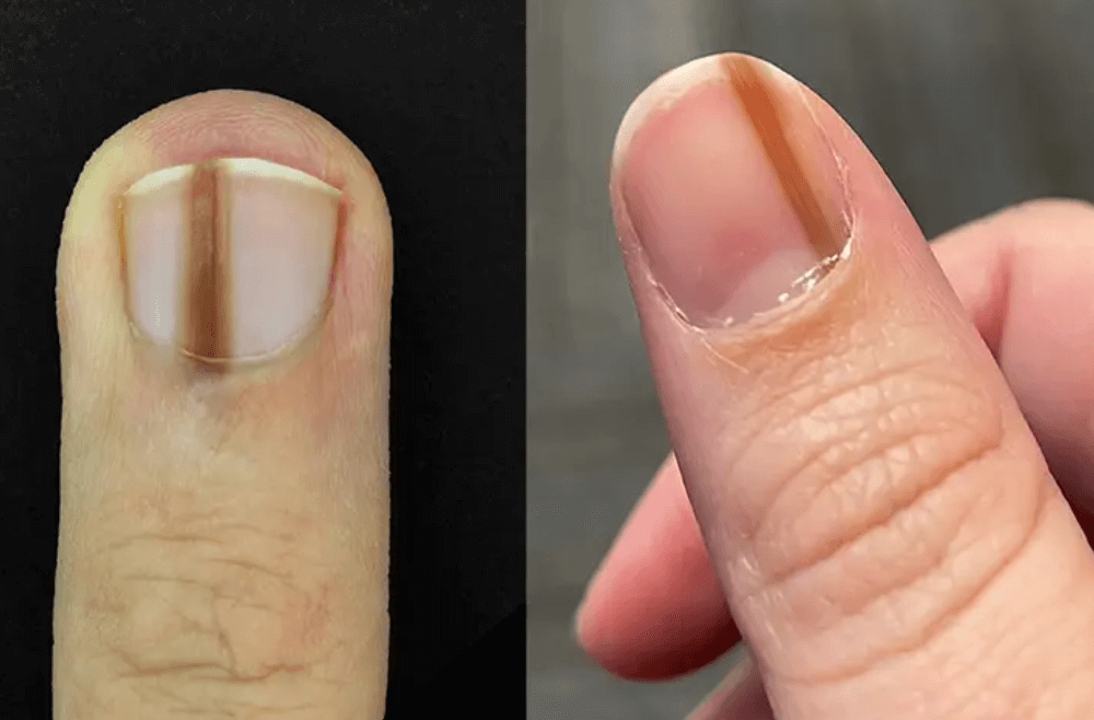 손톱 검은 세로줄