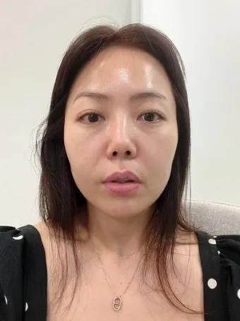 덴서티 리프팅 댄서티 가격 효과 유지기간에 관한 정보_21