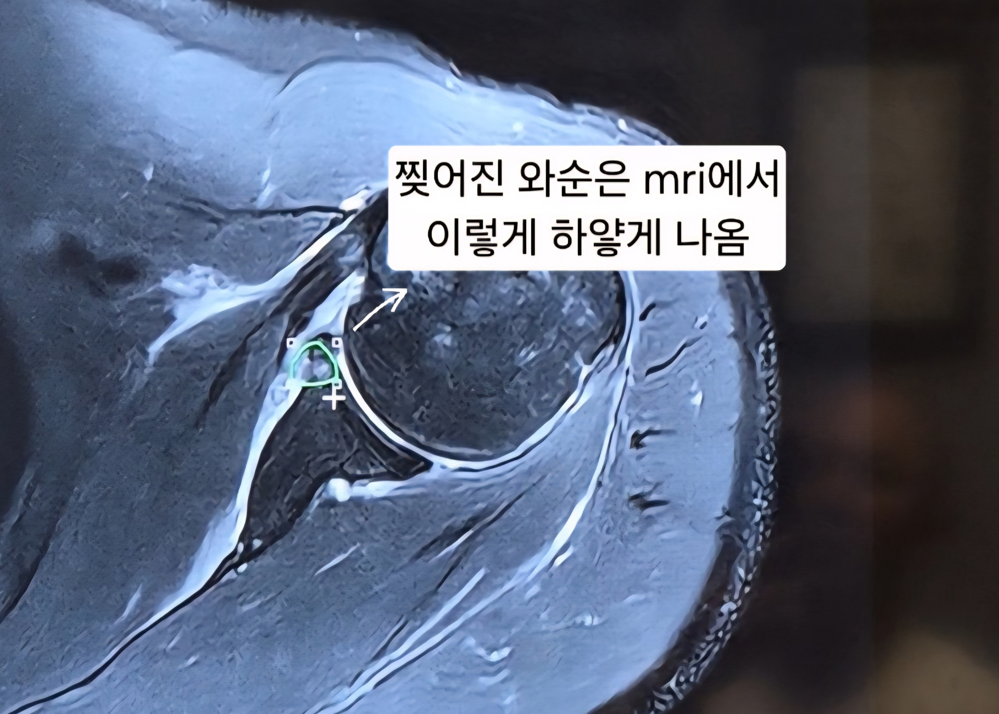 어깨 와순파열 봉합수술 후 mri사진 물리치료 기록