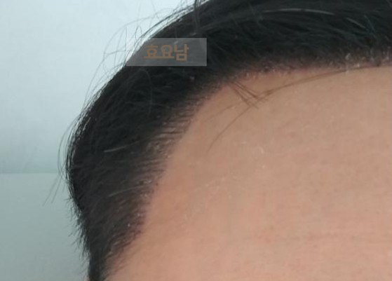 M자 모발이식-2주차 각질