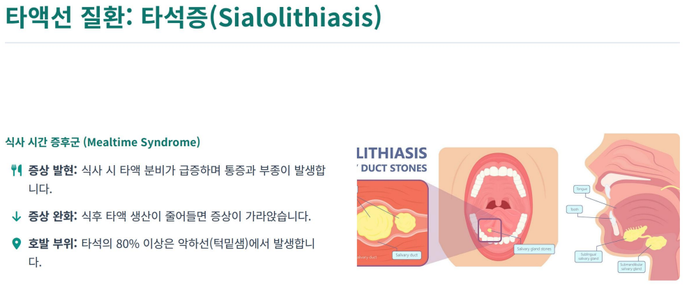 침샘의 배출구가 돌(타석)이나 다른 이유로 막혀 있는 이미지
