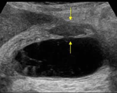 담낭 천공 (GB perforation)