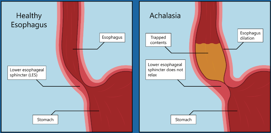 하부식도 괄약근이 이완되지 않는 모습