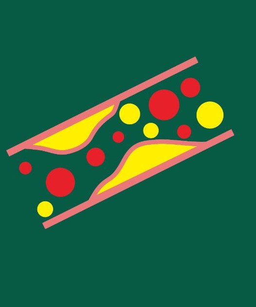 ldl콜레스테롤 정상수치 혈관 이미지