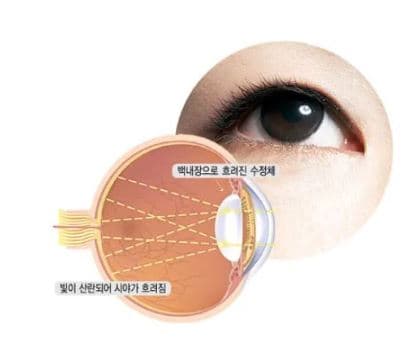 백내장 증상