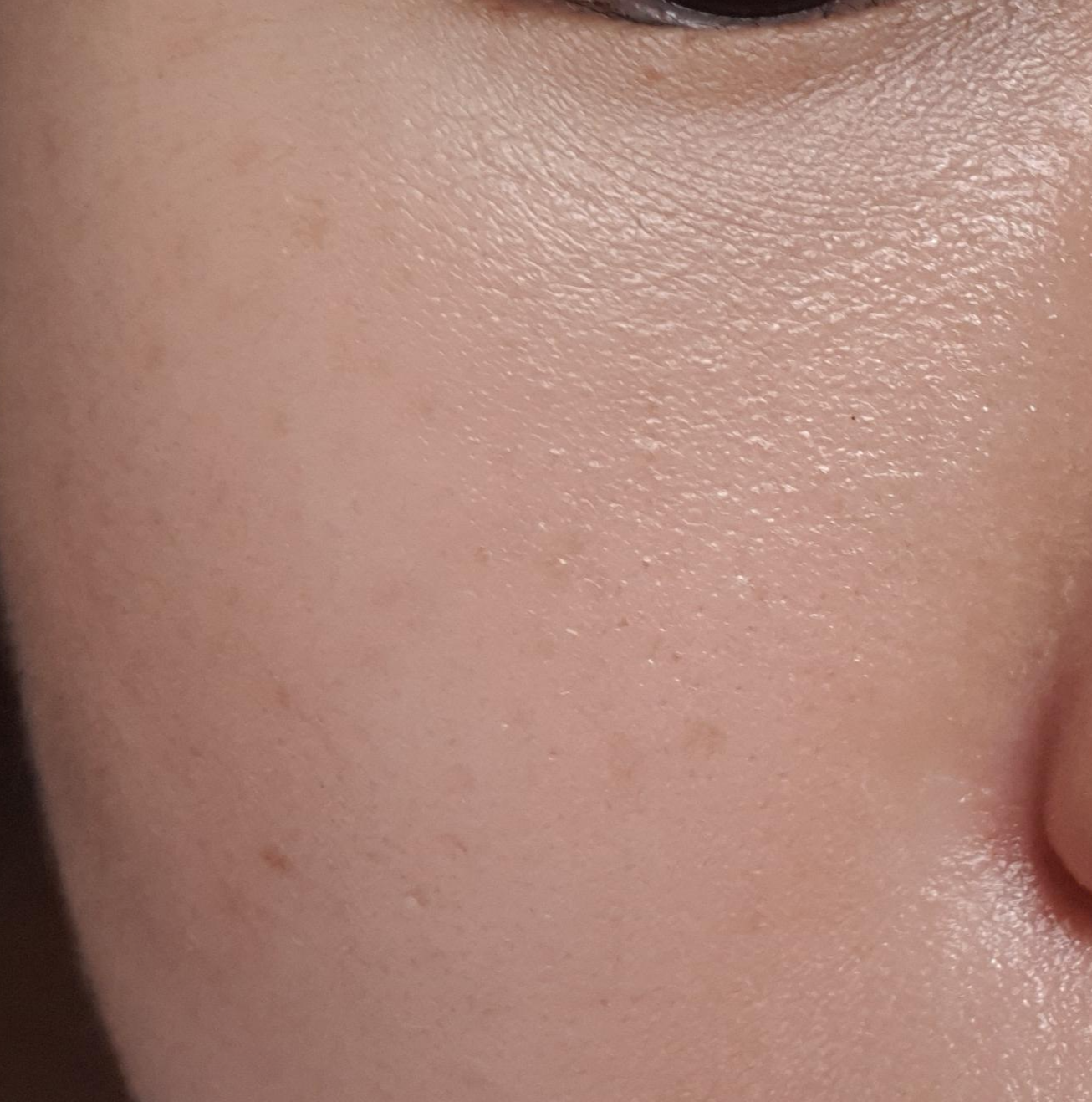 파우더 사용 후 6시간 뒤(왼쪽 뺨)