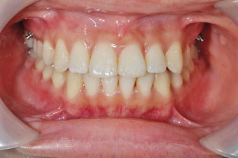 주기적인 치아 검진