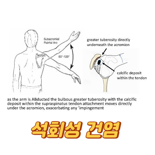 석회성 건염