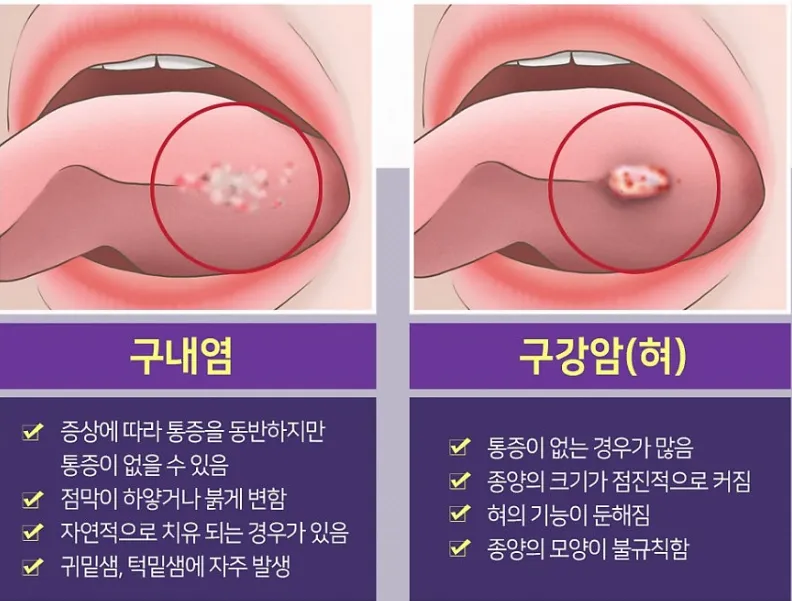 구내염과-구강암-증상비교
