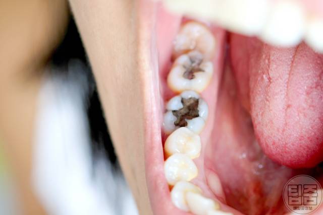 칼슘이 부족하면 나타나는 증상,충치