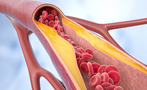 노화와 동맥경화