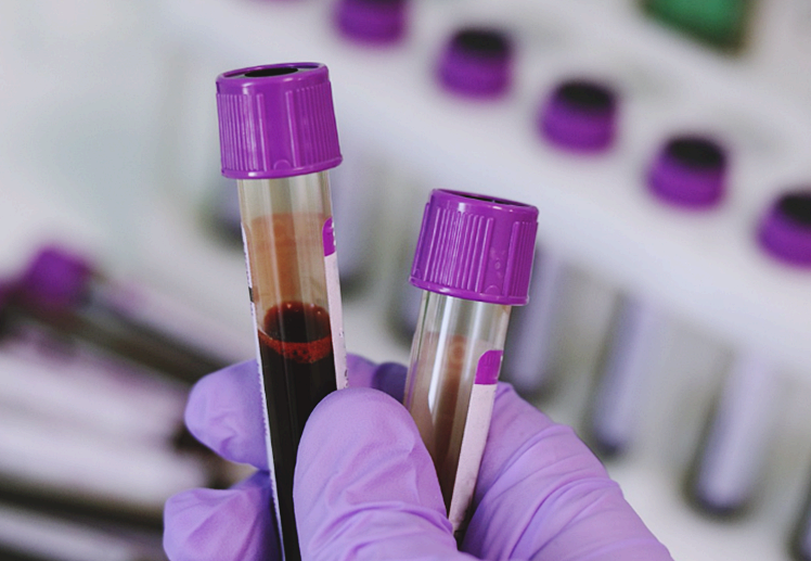 진행성 다초점성 백질뇌병증, 수개월 내에 사망할 수 있는 중추신경계 희귀 질환