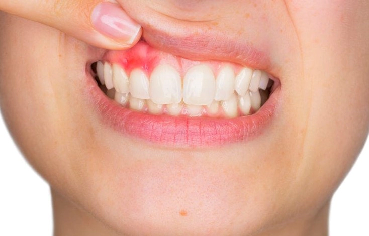 구내염 빨리 낫는 치료법