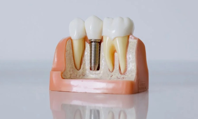 대전-유성구-임플란트-치과-가격-비용-싼-곳,저렴한-곳,잘하는-곳,유명한-곳-BEST20-추천11