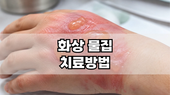 화상 물집 치료방법