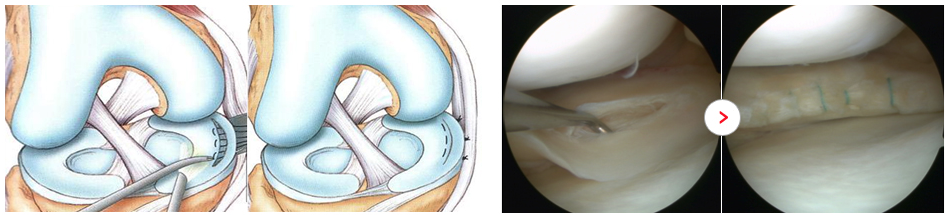 반월상연골 봉합술