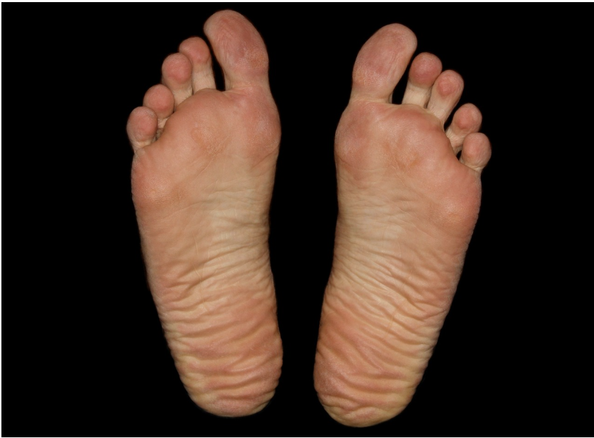 무좀, 흔하지만 방치하면 위험한 질환