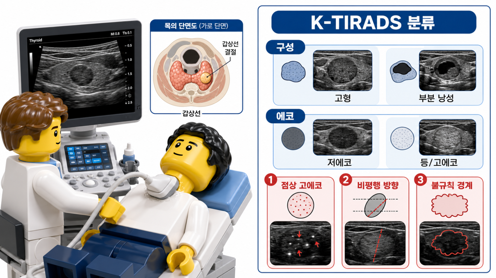 갑상선 초음파 검사와 K-TIRADS 분류 기준을 설명하는 의료 인포그래픽