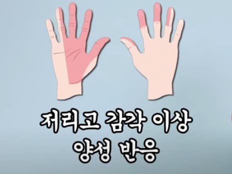 손목터널증후군-증상