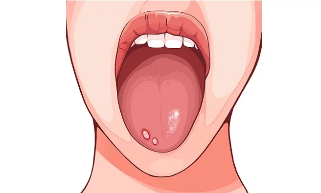 혓바늘이 돋는 이유 원인과 혓바늘 없애는 방법 꿀 치료법 자주돋는 현상