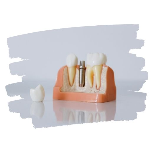 평택 임플란트 잘하는 곳